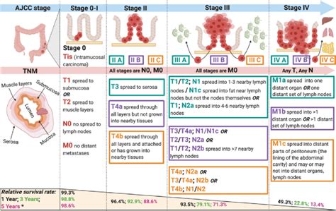 Lymph Cancer Stages