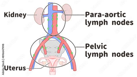 Lymph Nodes Para Aortic