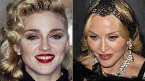 Madonna Plastic Surgery Face