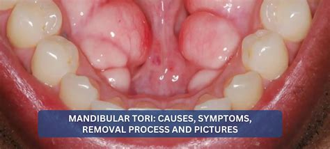Mandibular Tori Images