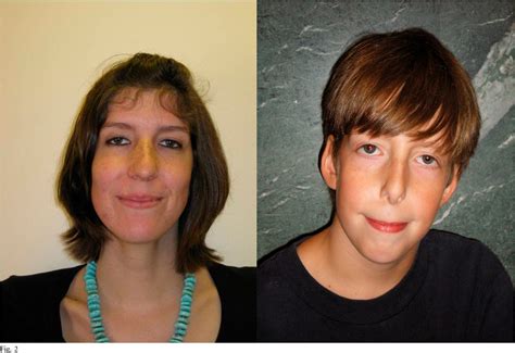 Marfan Syndrome Face