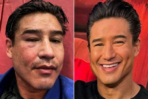 Mario Lopez Plastic Surgery Face