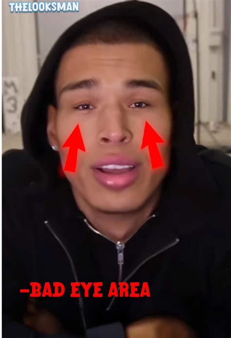 Marlon Face Surgery