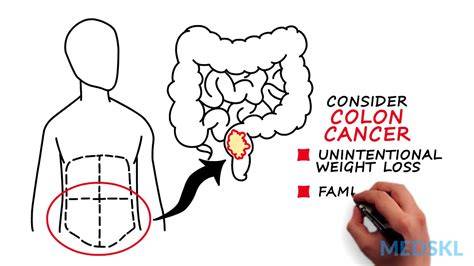 Mass In Stomach