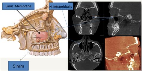Maxillary Sinus Cyst