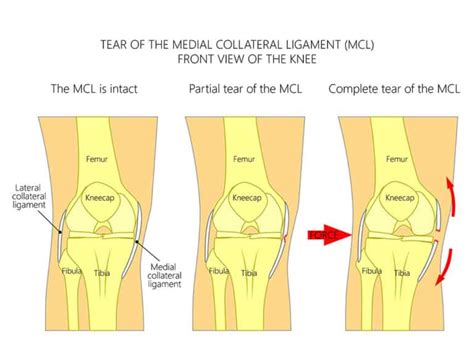 Mcl Recovery Time