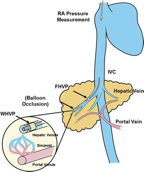 Measurement Of Portal Hypertension