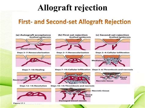 Mechanism Of Graft Rejection
