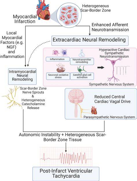 Mechanism Of Ventricular Tachycardia