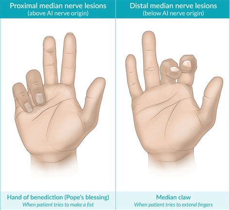 Median Nerve Injury