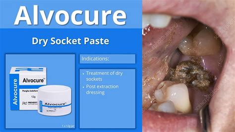 Medicated Dressing For Dry Socket