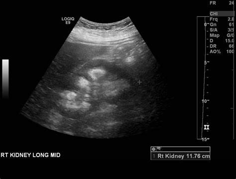Medullary Sponge Kidney In Ultrasound