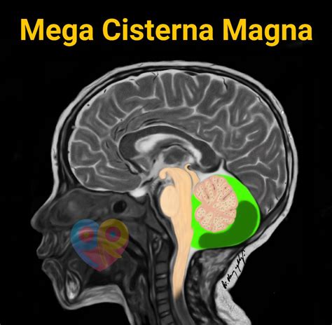 Mega Cisterna Magna