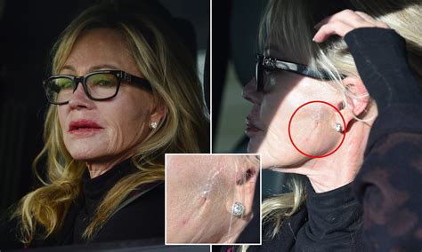 Melanie Griffith Face Surgery Lion