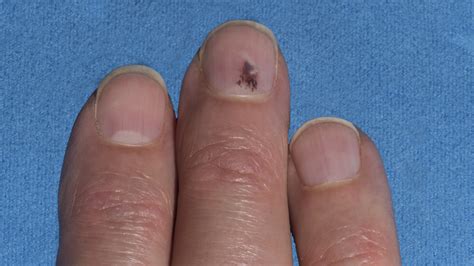 Melanoma Cancer Under Fingernail