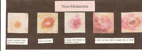 Melanoma Non Melanoma