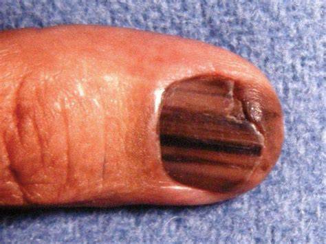 Melanoma Under Nail Bed