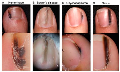 Melanoma Under Nail
