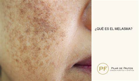 Melasma Que Es