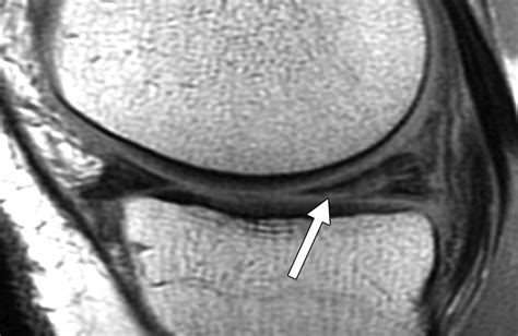 Meniscus Tear Mri