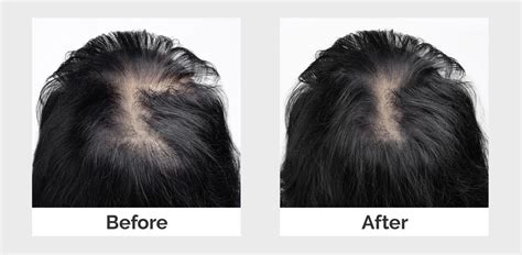 Menopause Hair Loss Treatment