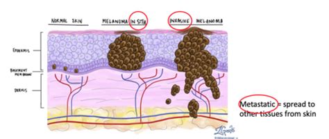 Metastatic Melanoma Skin Cancer Medication