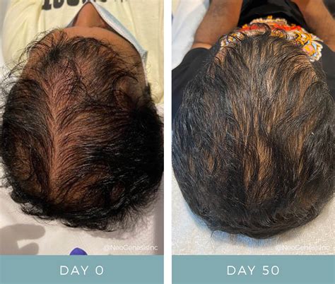 Microneedling For Hair Growth