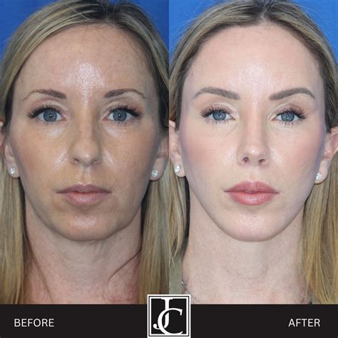 Mid Face Lift