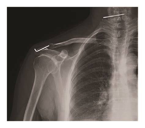 Migration Of K Wire