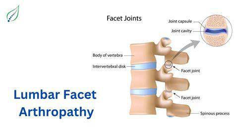 Mild Facet Arthropathy