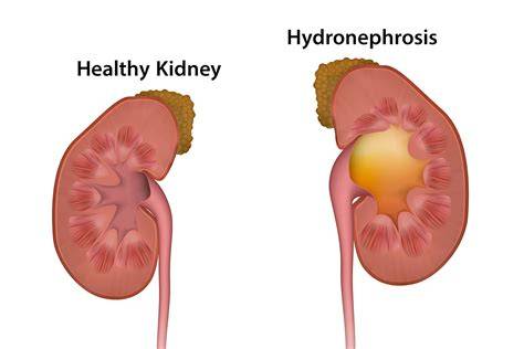 Mild Hydronephrosis In Left Kidney