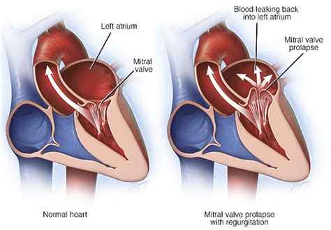 Mild Mitral Incompetence