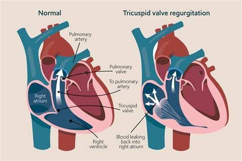 Mild Tricuspid Regurgitation Symptoms