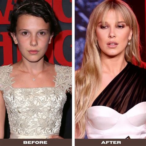 Millie Bobby Brown Face Surgery