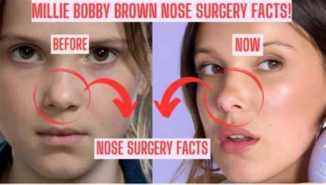 Millie Ramsey Face Surgery