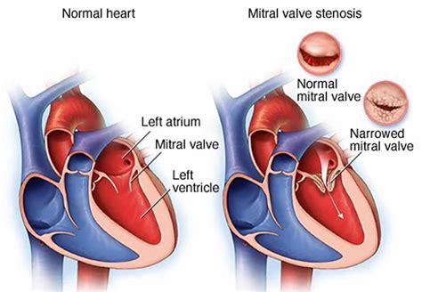 Mitral Stenosis Adalah