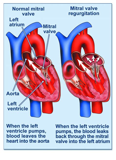 Mitral Valve Fix