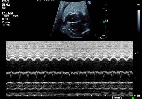 Mmode Fetal Heart Rate