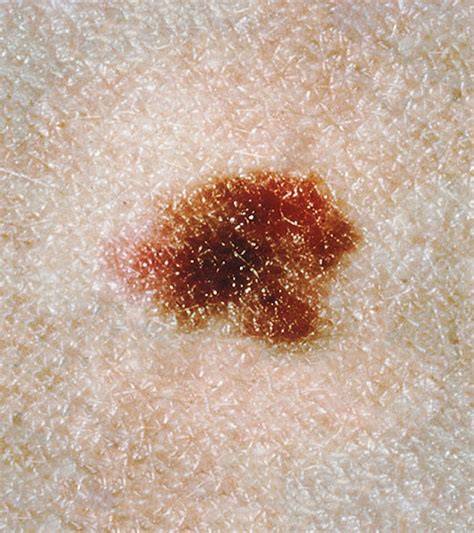 Moderate Dysplasia Nevus