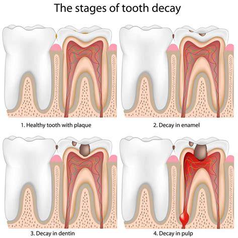 Molar Tooth Decay