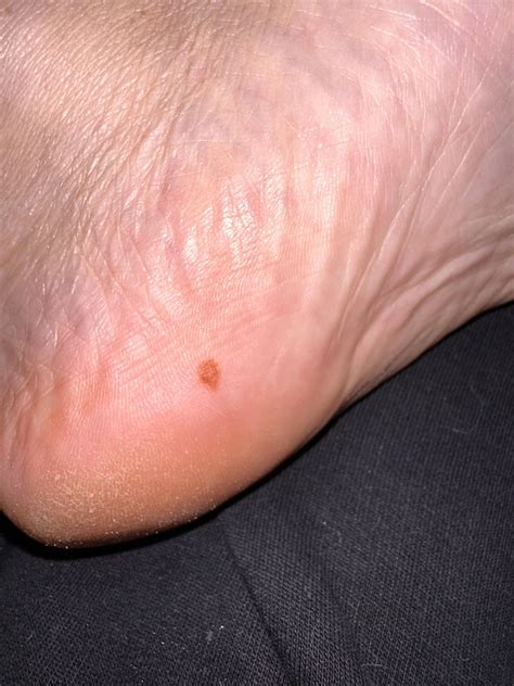 Mole On The Sole