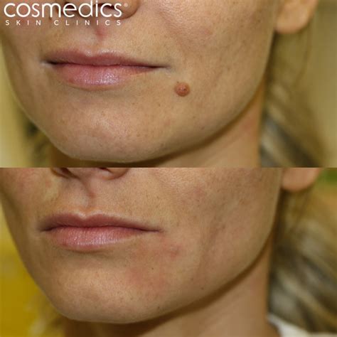 Mole Removal On Face