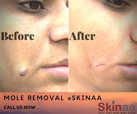 Mole Removal Scar