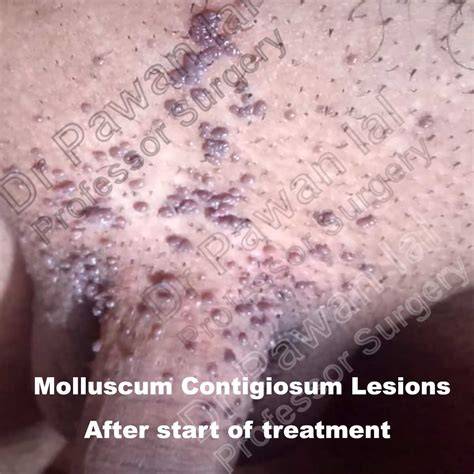 Molluscum On Penis Shaft