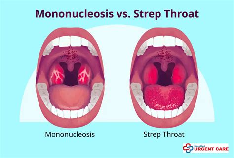 Mono Throat Vs Strep Throat