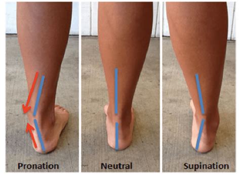 More Than Vs Over Pronation
