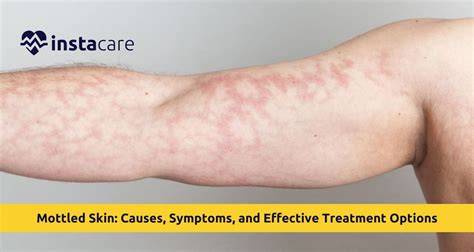 Mottled Skin Causes