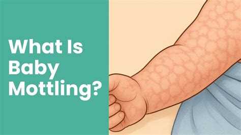Mottling Of Skin In Newborns