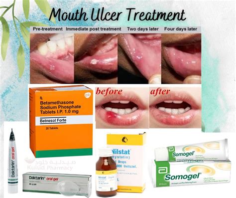 Mouth Sores Treatment