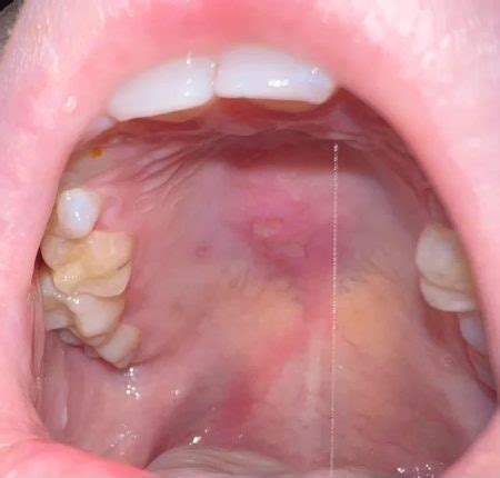 Mouth Ulcer Roof Of Mouth